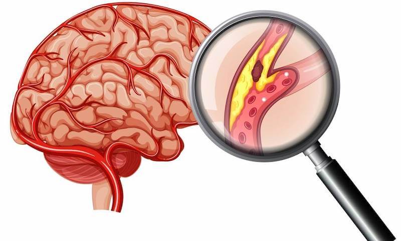 Атеросклероз сосудов головного мозга – симптомы и признаки